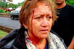 Rapa Nui woman wounded by a rubber bullet 