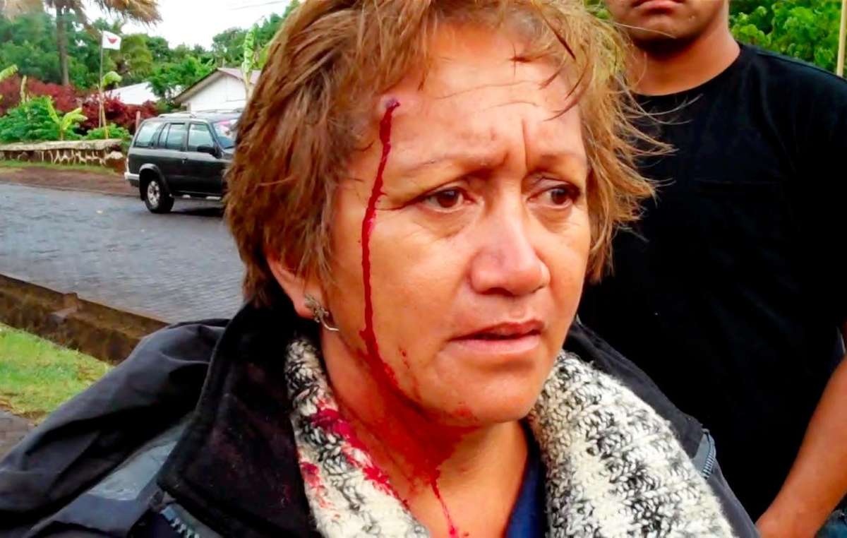 Femme rapa nui blessée par une balle en caoutchouc