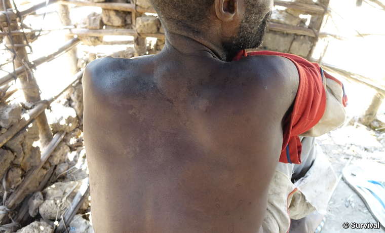 A man from a village near the proposed Messok Dja national park shows scars from a beating he received at the hands of ecoguards supported and funded by WWF