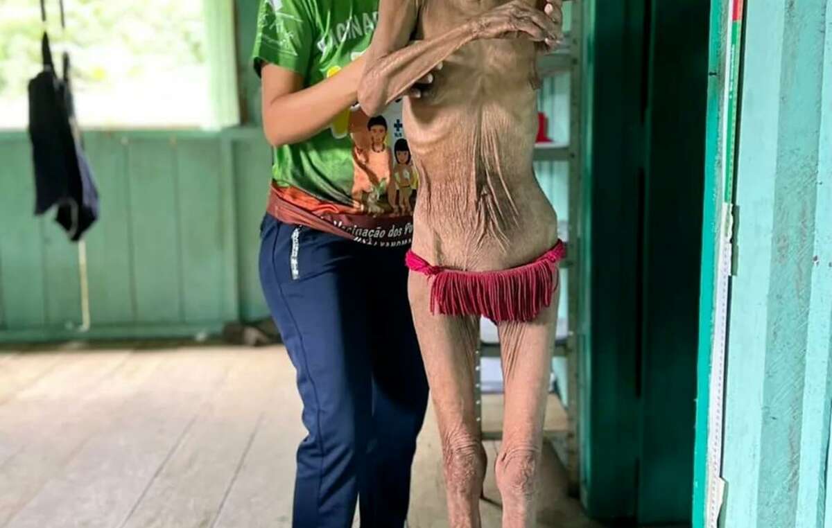 Stark unterernährte Yanomami-Frau in der Region Surucucus.