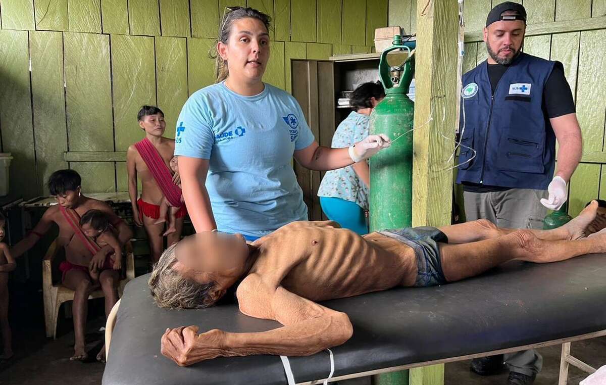 Indígena Yanomami severamente desnutrido é examinado por agentes de saúde.